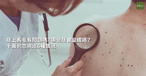 長毛的痣|痣上長毛有問題嗎？哪些痣會變成癌？千萬別忽視這6種情況